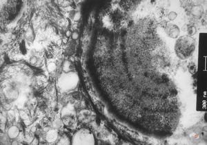 M,66y. | follicular cyst with hyaline Rushton bodies M,66y. | follicular cyst with hyaline Rushton bodies